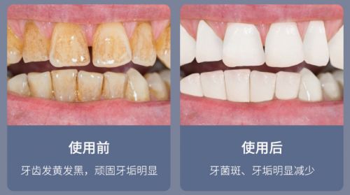 告別刷牙盲區(qū)，現(xiàn)代口腔護(hù)理新選擇 為何它能解決你的深層困擾